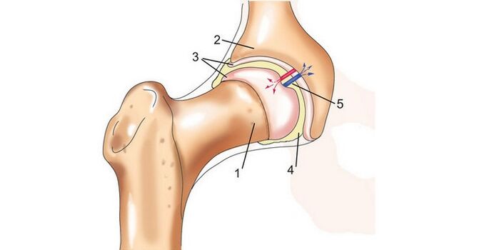 articulación da cadeira e artrose